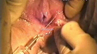 真实医院偷拍处女膜再造修补术实录 百分百真正的处女 高清1080P版